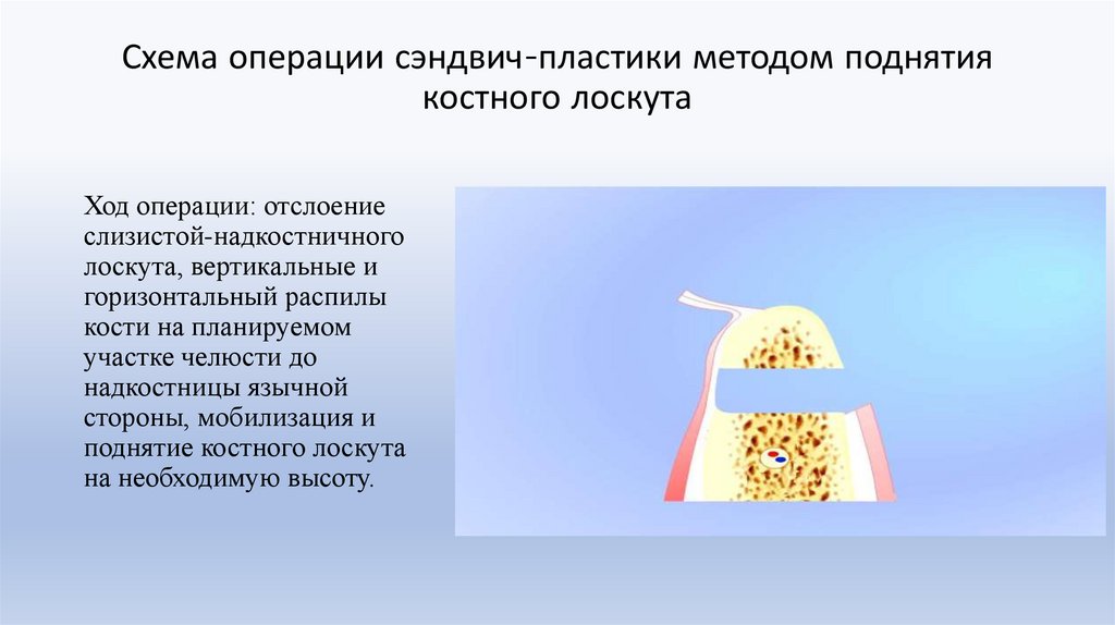 Схема операции сэндвич-пластики методом поднятия костного лоскута