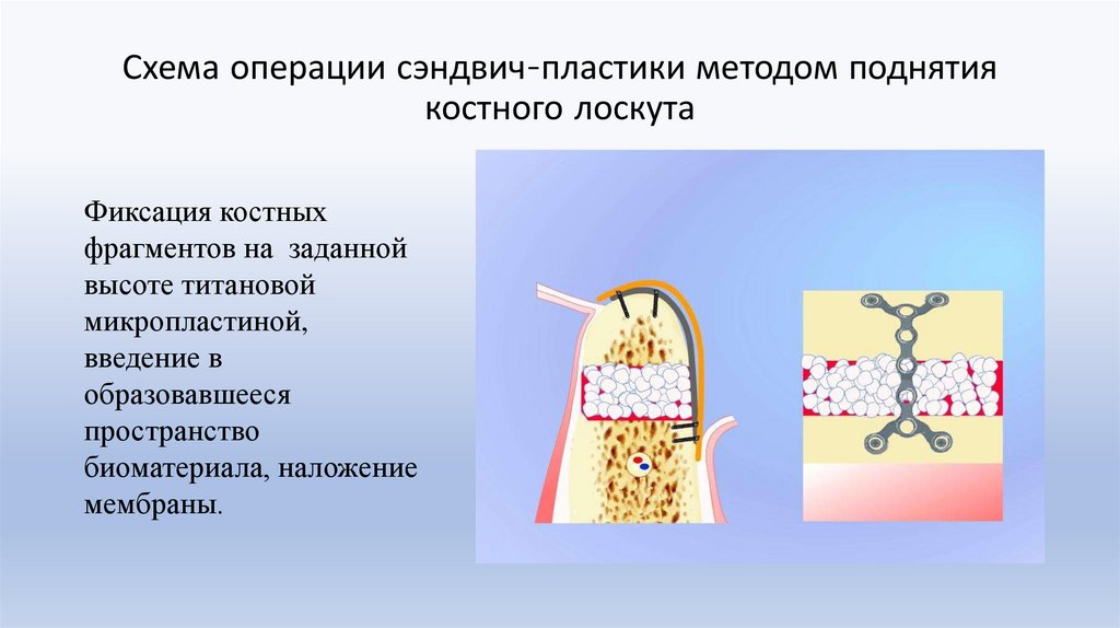 Схема операции сэндвич-пластики методом поднятия костного лоскута
