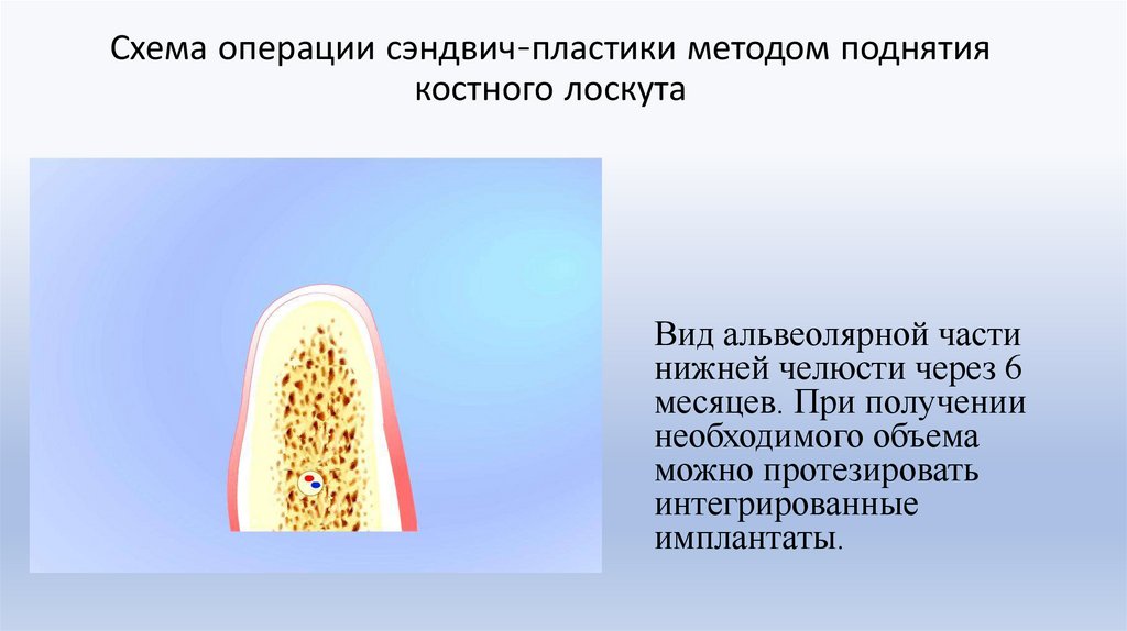 Схема операции сэндвич-пластики методом поднятия костного лоскута