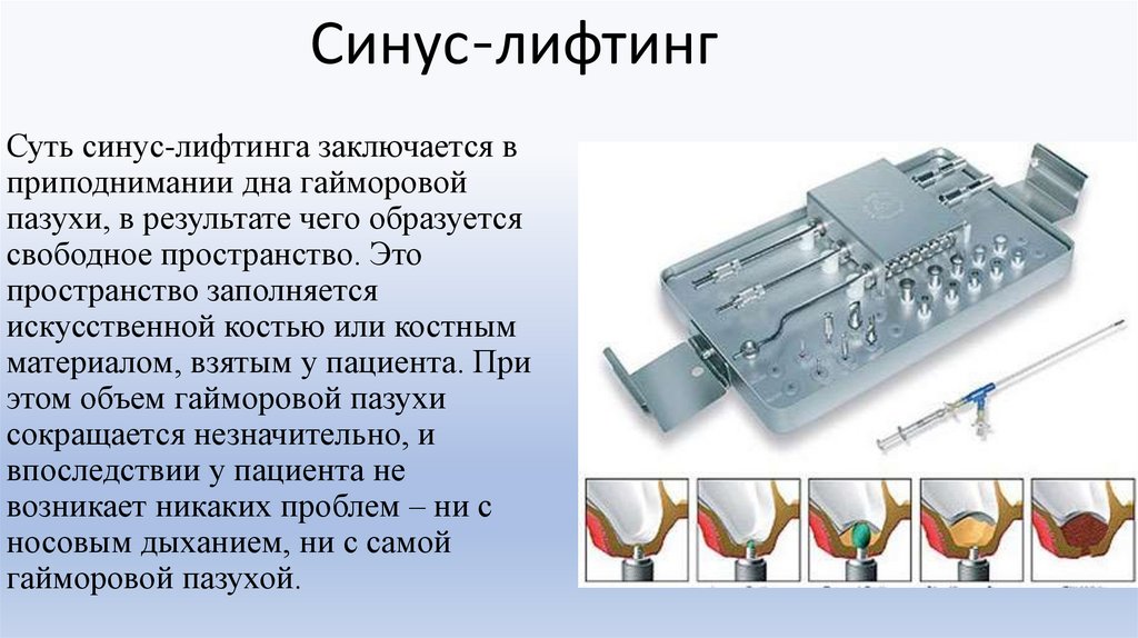 Синус-лифтинг