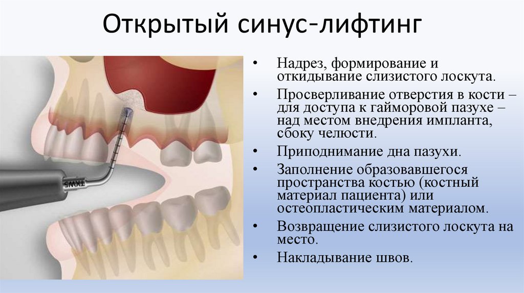 Открытый синус-лифтинг