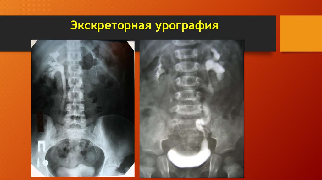 Экскреторная урография