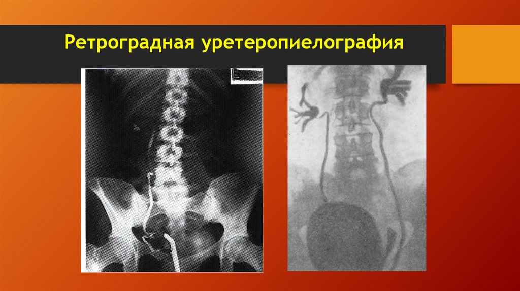 Ретроградная уретеропиелография