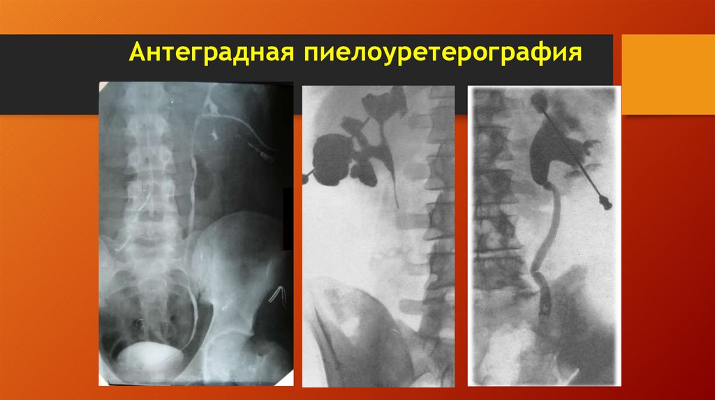 Антеградная пиелоуретерография