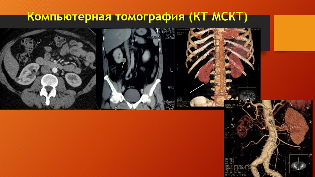 Компьютерная томография (КТ МСКТ)