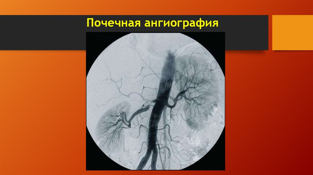 Почечная ангиография