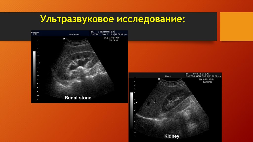 Ультразвуковое исследование: