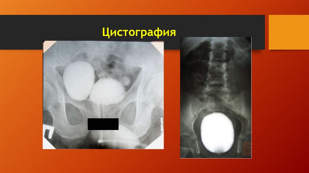 Цистография
