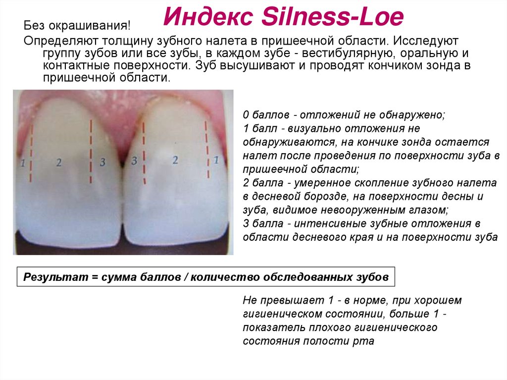 Индекс Silness-Loe