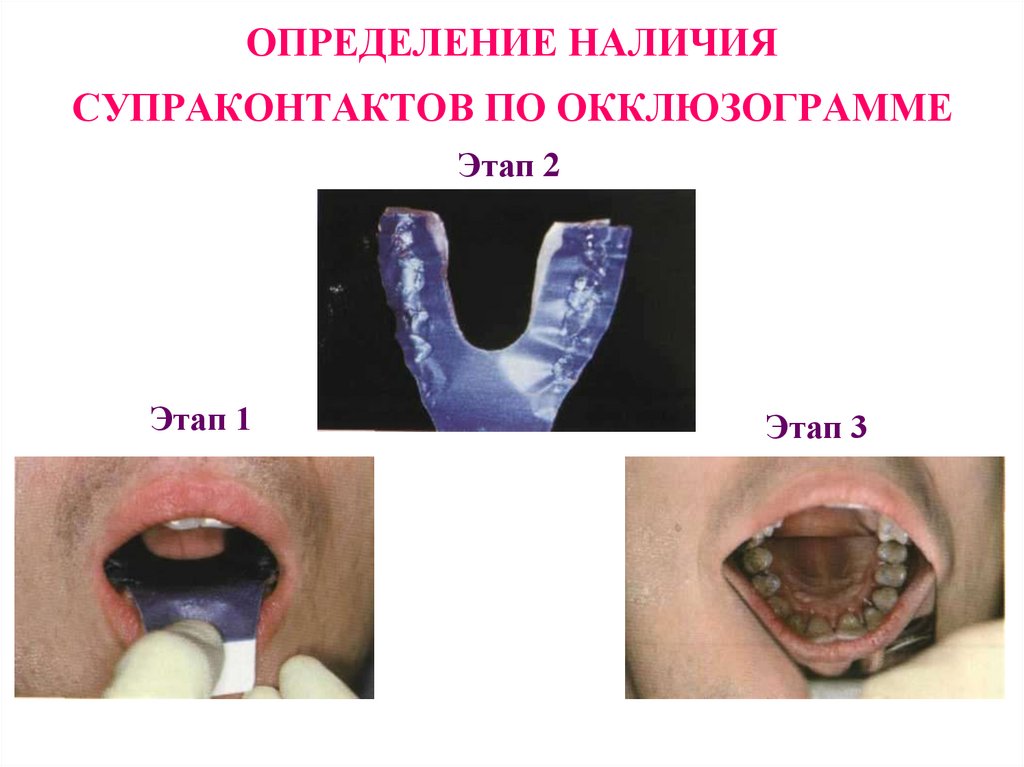 ОПРЕДЕЛЕНИЕ НАЛИЧИЯ СУПРАКОНТАКТОВ ПО ОККЛЮЗОГРАММЕ