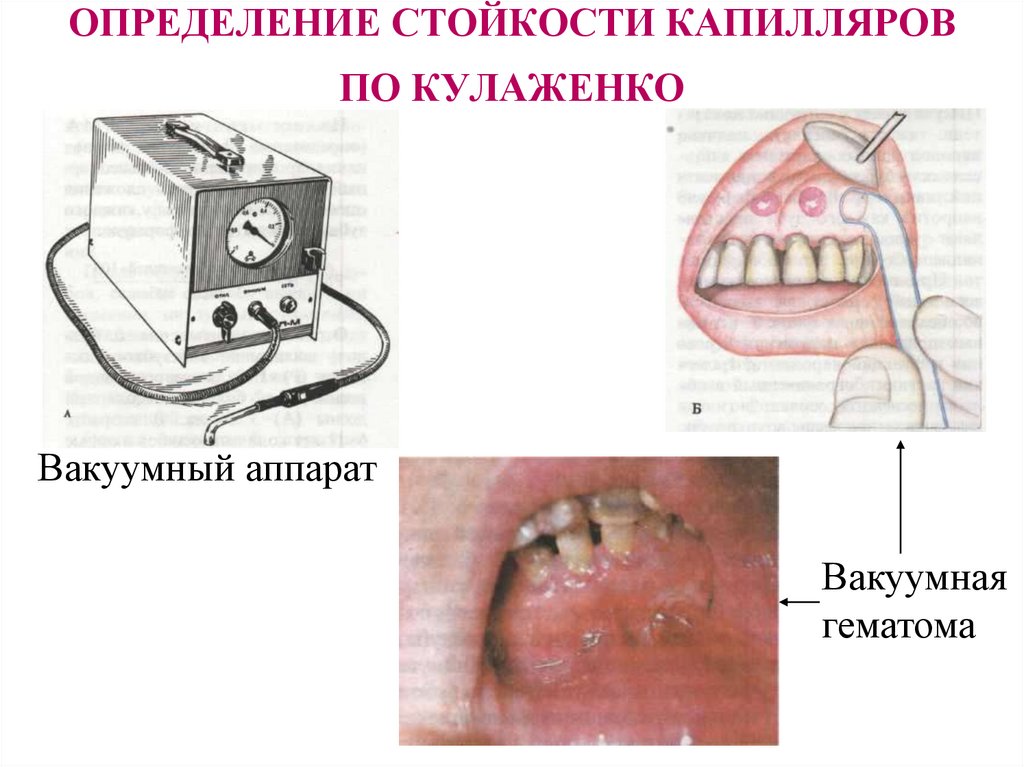 ОПРЕДЕЛЕНИЕ СТОЙКОСТИ КАПИЛЛЯРОВ ПО КУЛАЖЕНКО