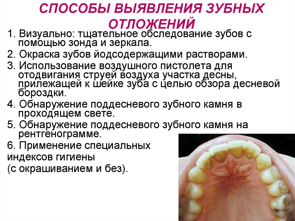 СПОСОБЫ ВЫЯВЛЕНИЯ ЗУБНЫХ ОТЛОЖЕНИЙ