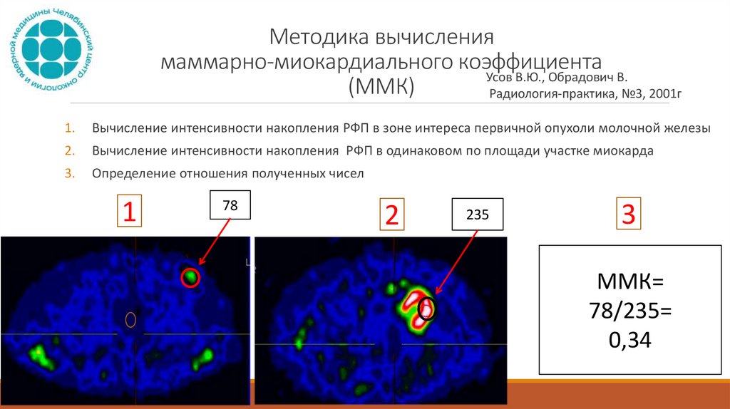 Методика вычисления маммарно-миокардиального коэффициента (ММК)
