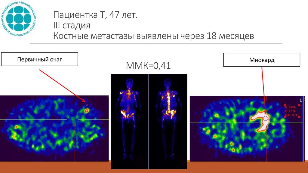 Пациентка Т, 47 лет. III стадия Костные метастазы выявлены через 18 месяцев