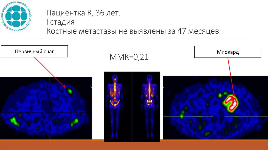 Пациентка К, 36 лет. I стадия Костные метастазы не выявлены за 47 месяцев