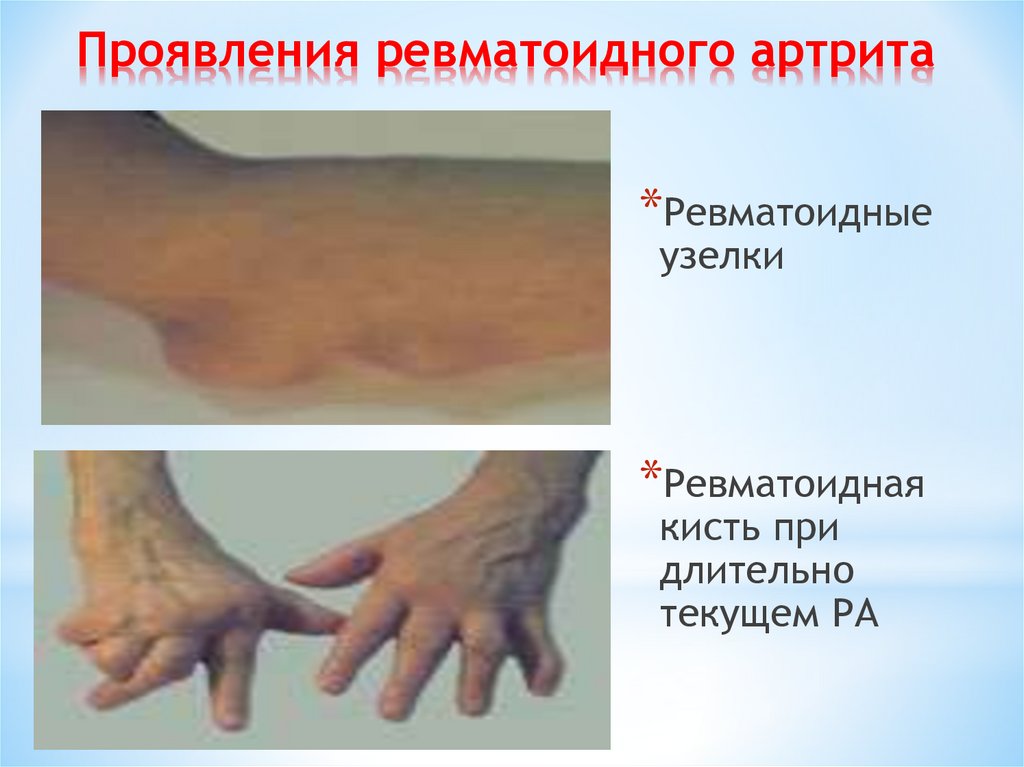 Проявления ревматоидного артрита