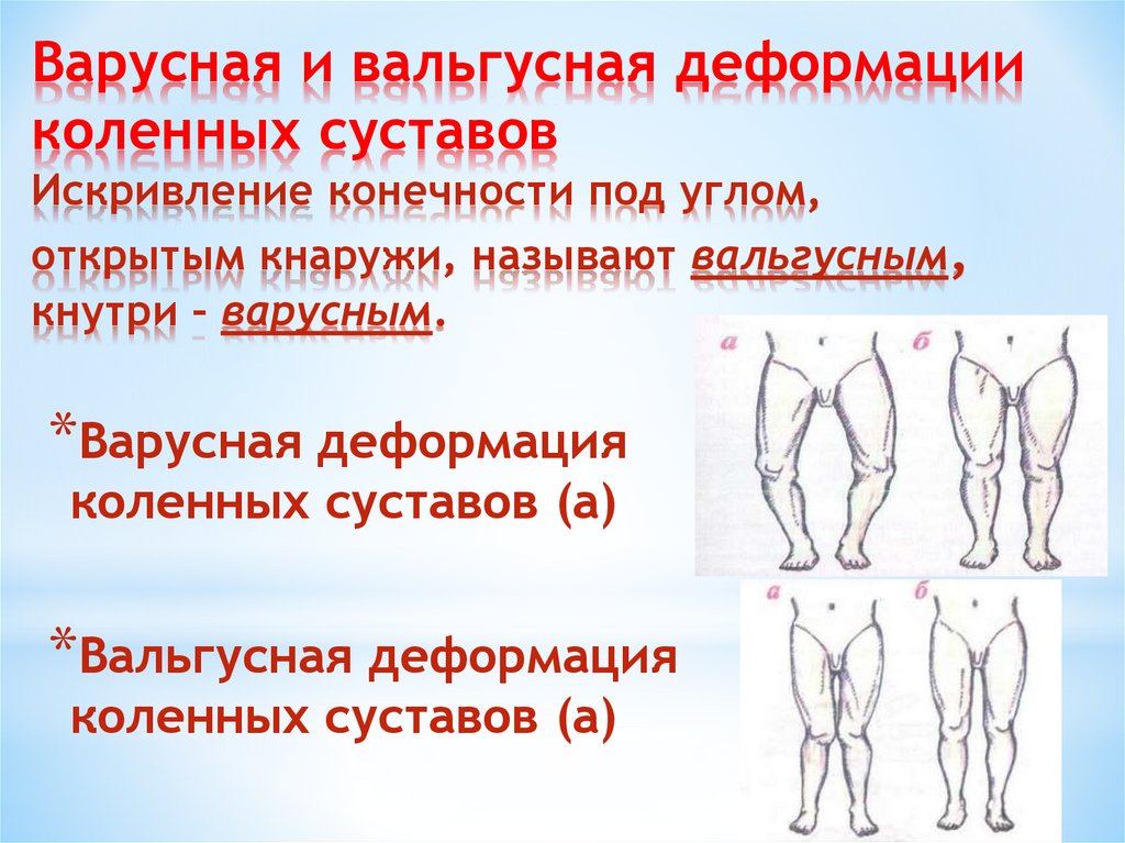 Варусная и вальгусная деформации коленных суставов Искривление конечности под углом, открытым кнаружи, называют вальгусным,
