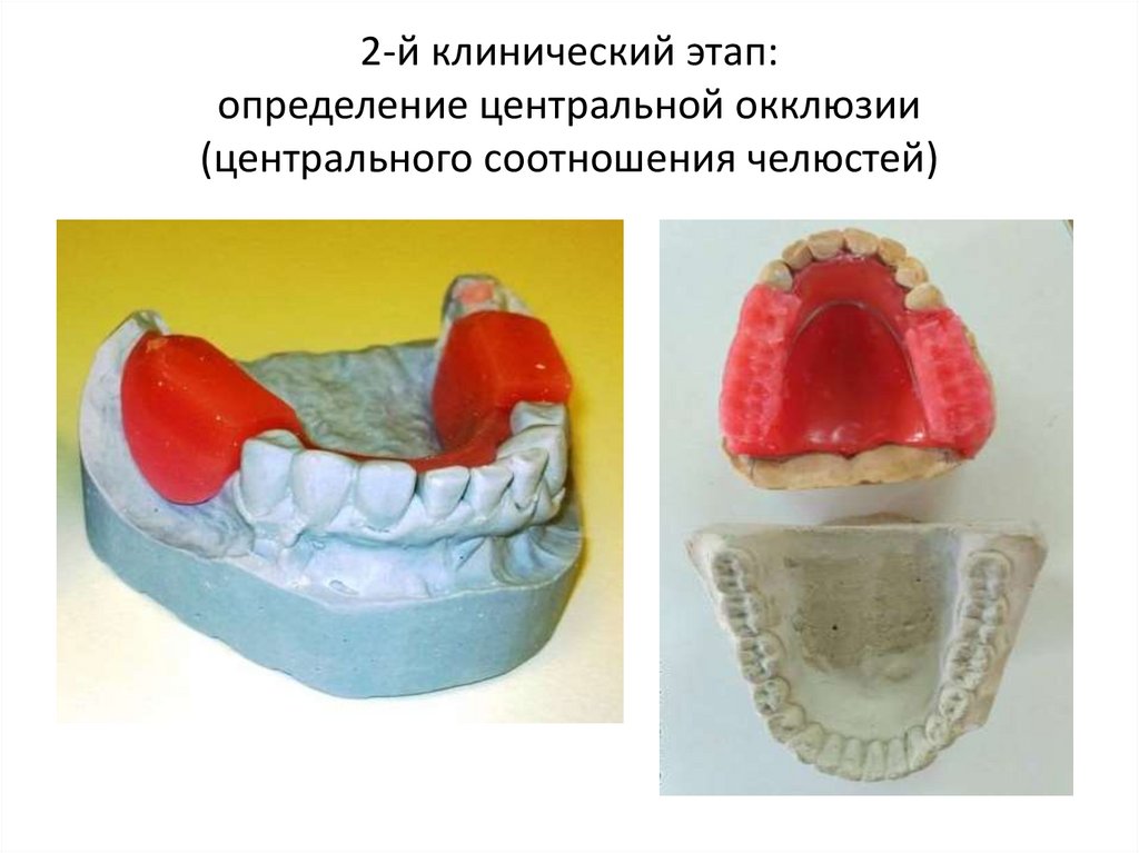 2-й клинический этап: определение центральной окклюзии (центрального соотношения челюстей)