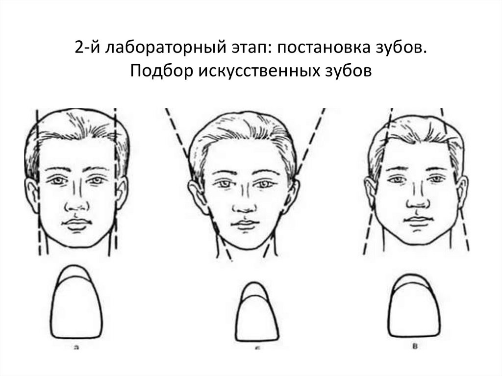 2-й лабораторный этап: постановка зубов. Подбор искусственных зубов