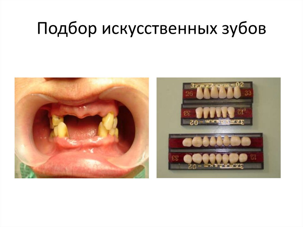 Подбор искусственных зубов