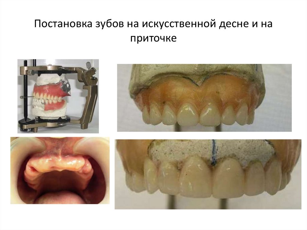 Постановка зубов на искусственной десне и на приточке