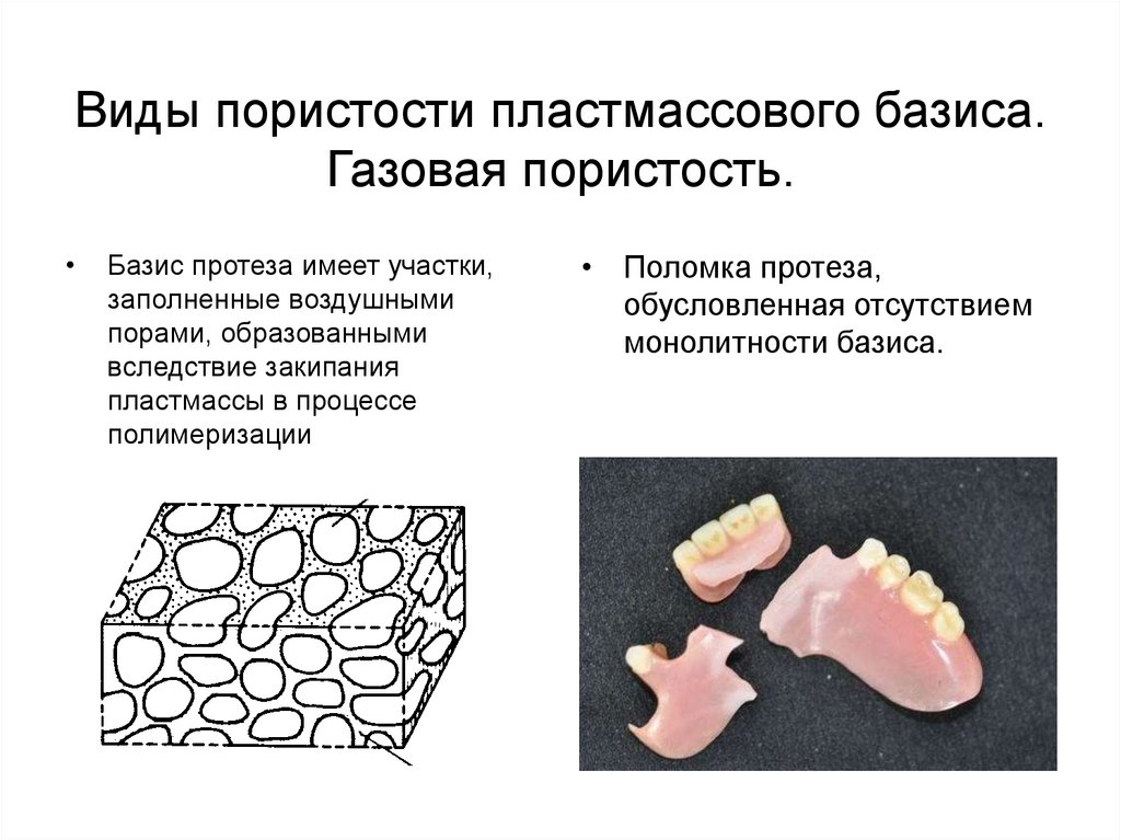 Виды пористости пластмассового базиса. Газовая пористость.