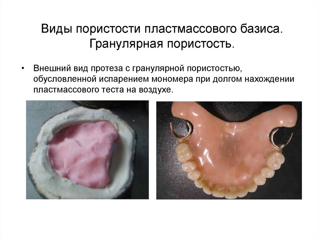Виды пористости пластмассового базиса. Гранулярная пористость.