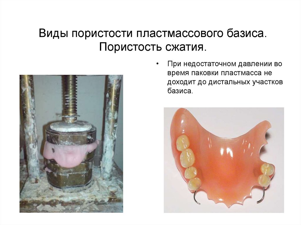 Виды пористости пластмассового базиса. Пористость сжатия.