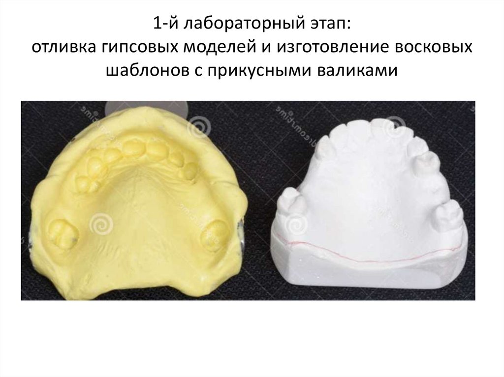1-й лабораторный этап: отливка гипсовых моделей и изготовление восковых шаблонов с прикусными валиками