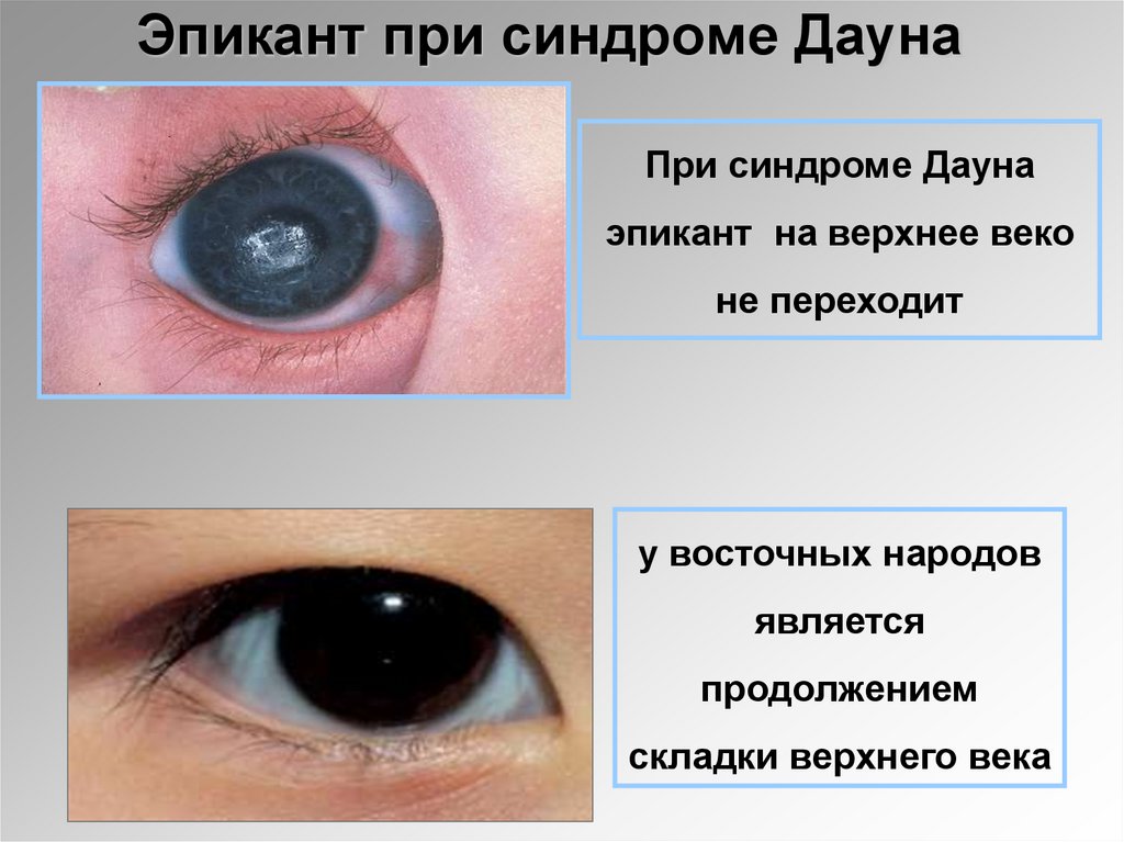 Эпикант при синдроме Дауна