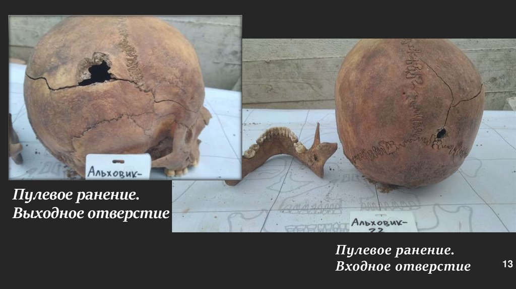 Пулевое ранение. Входное отверстие