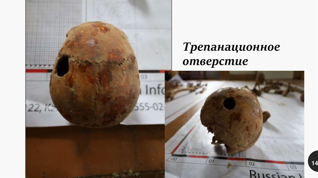 Трепанационное отверстие