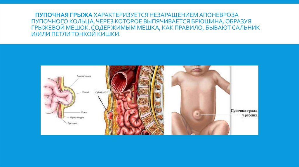 Пупочная грыжа характеризуется незаращением апоневроза пупочного кольца, через которое выпячивается брюшина, образуя грыжевой