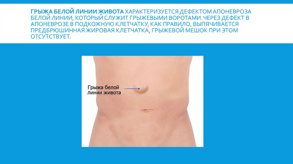 Грыжа белой линии живота характеризуется дефектом апоневроза белой линии, который служит грыжевыми воротами. Через дефект в