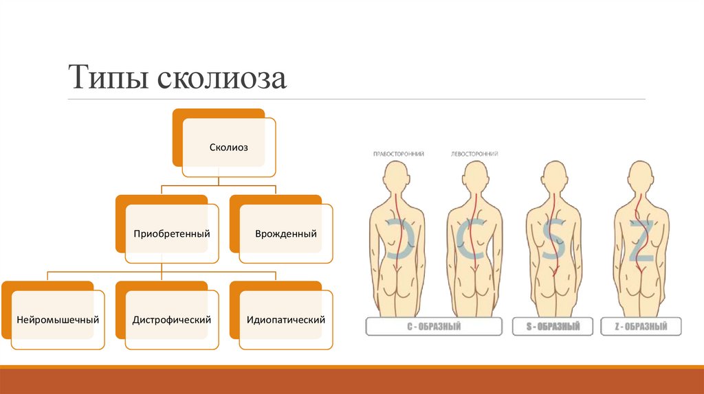 Типы сколиоза