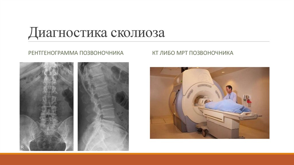 Диагностика сколиоза