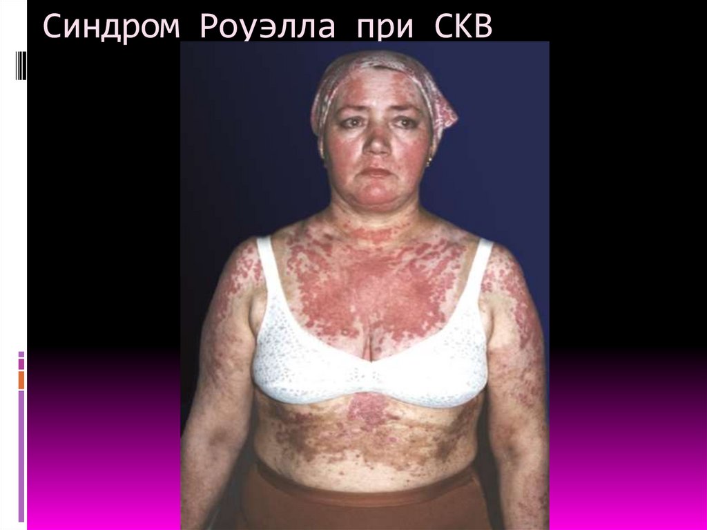 Синдром Роуэлла при СКВ