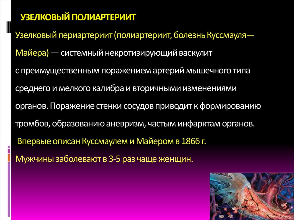 УЗЕЛКОВЫЙ ПОЛИАРТЕРИИТ Узелковый периартериит (полиартериит, болезнь Куссмауля—Майера) — системный некротизирующий васкулит с
