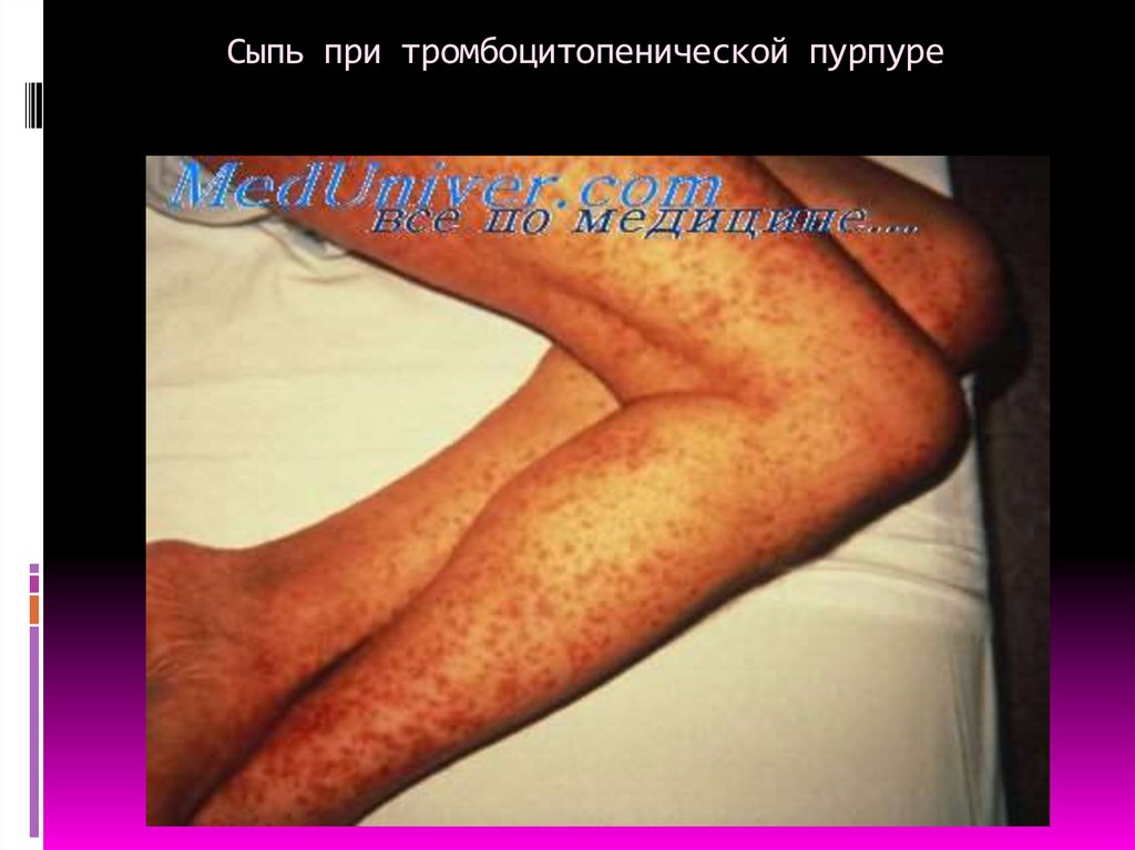 Сыпь при тромбоцитопенической пурпуре
