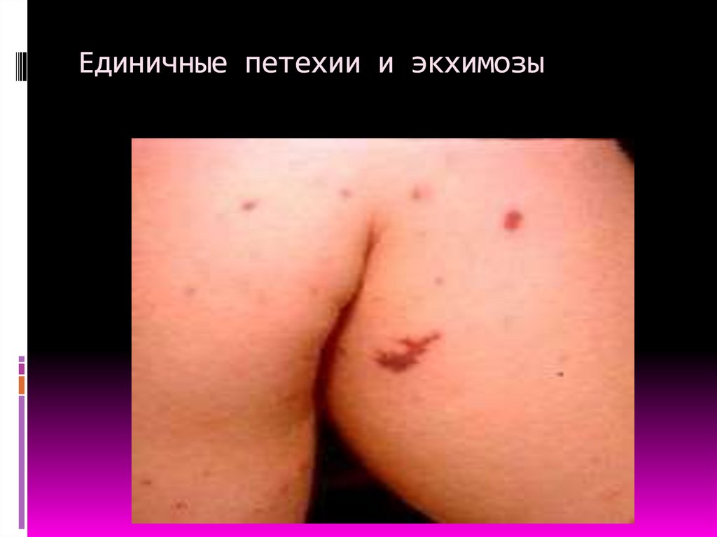Единичные петехии и экхимозы