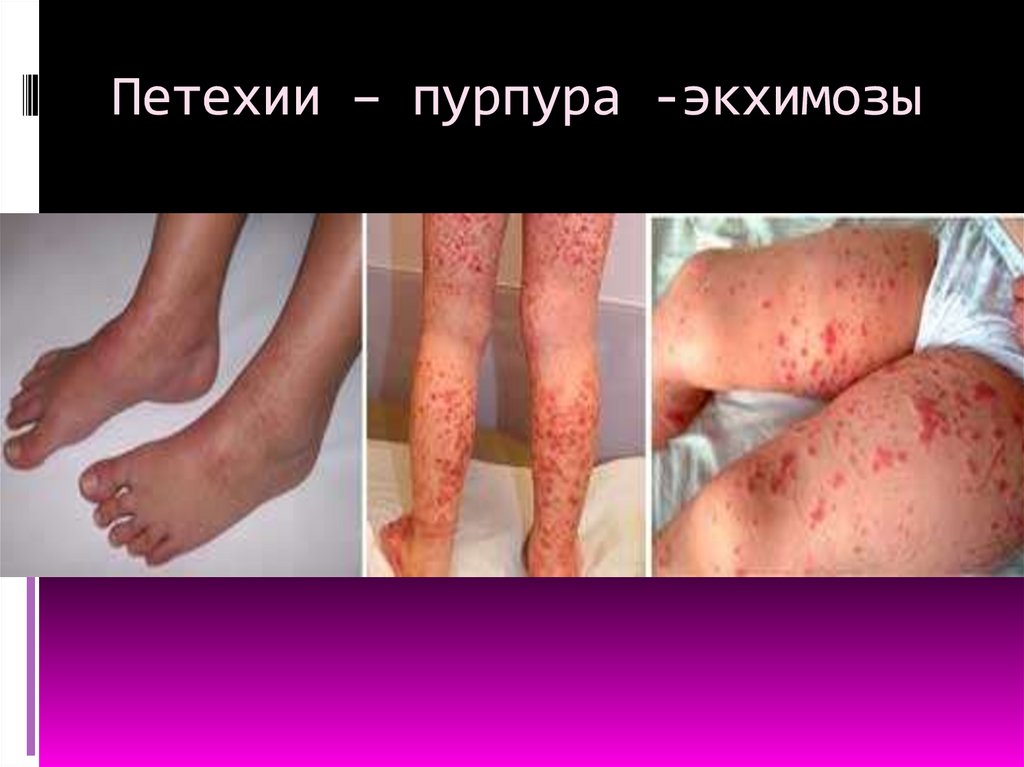 Петехии – пурпура -экхимозы