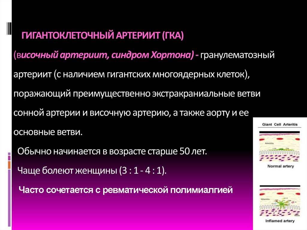 ГИГАНТОКЛЕТОЧНЫЙ АРТЕРИИТ (ГКА) (височный артериит, синдром Хортона) - гранулематозный артериит (с наличием гигантских
