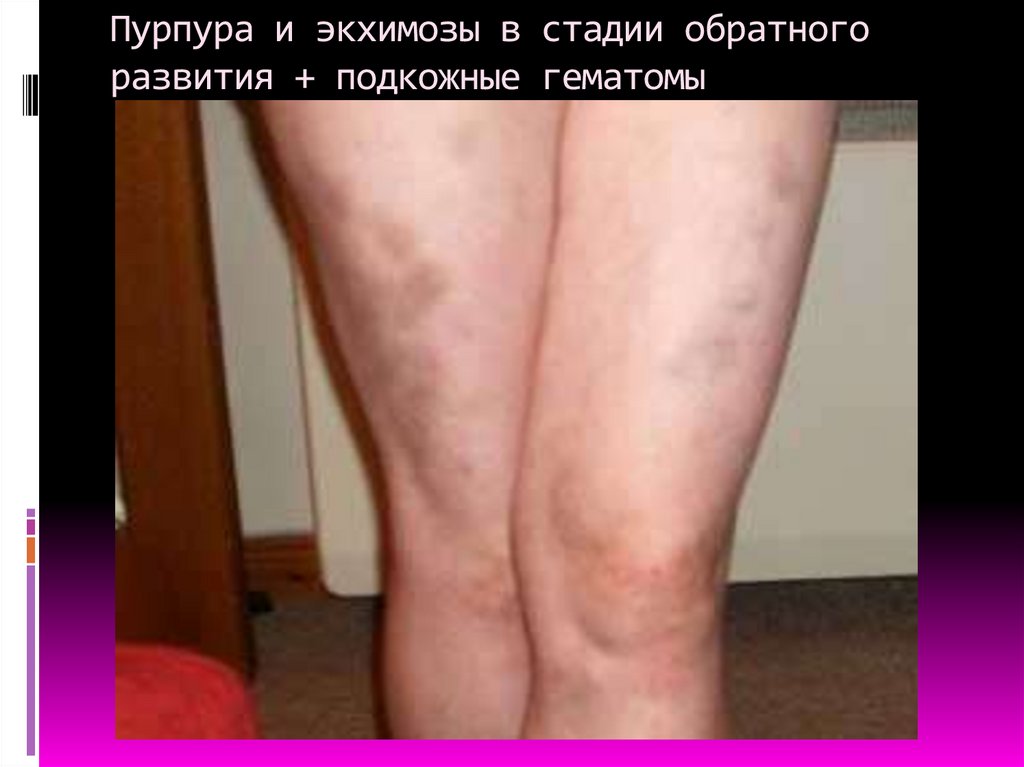 Пурпура и экхимозы в стадии обратного развития + подкожные гематомы