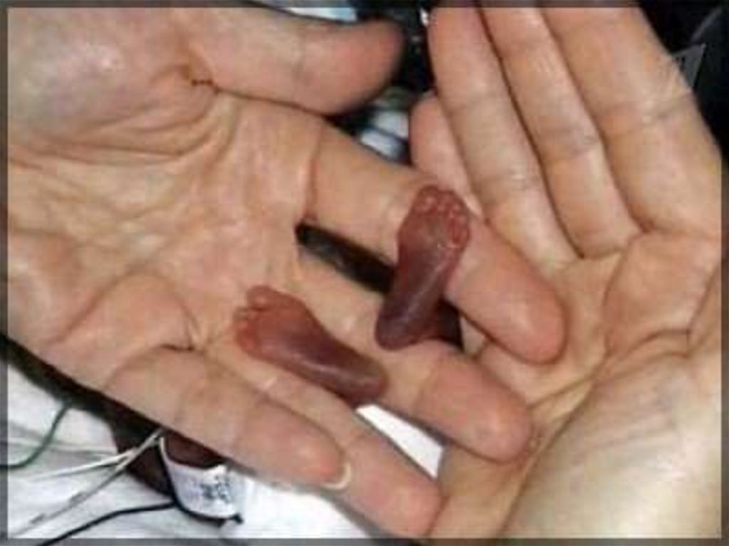 Признаки незрелости новорожденного: