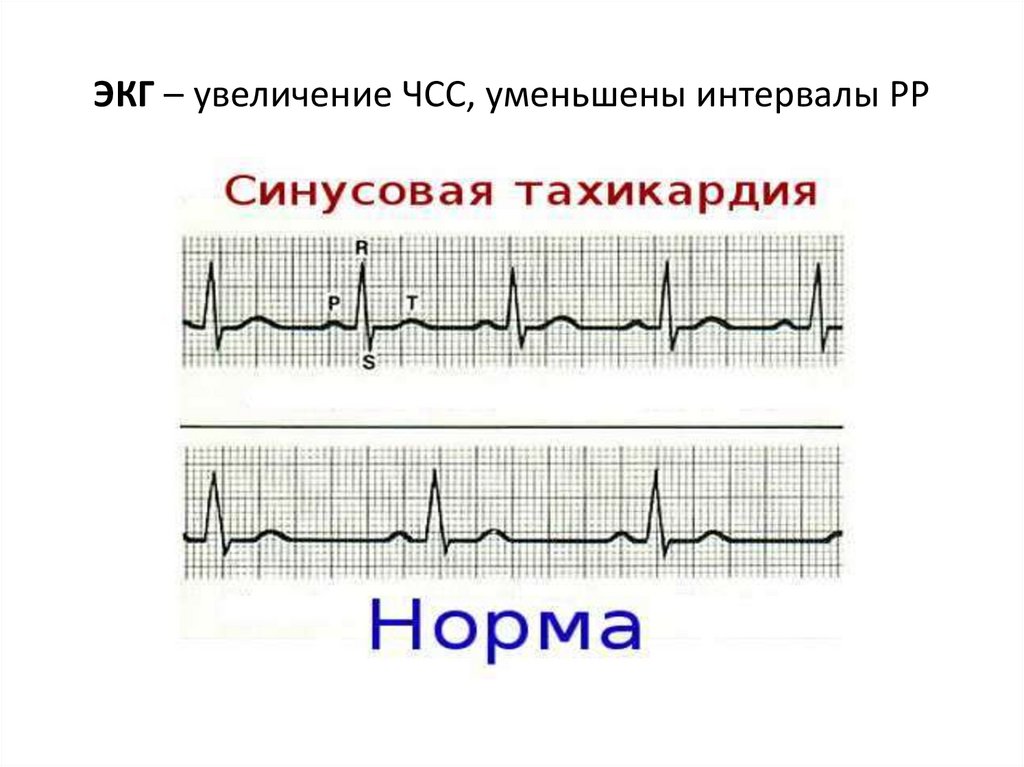 ЭКГ – увеличение ЧСС, уменьшены интервалы РР