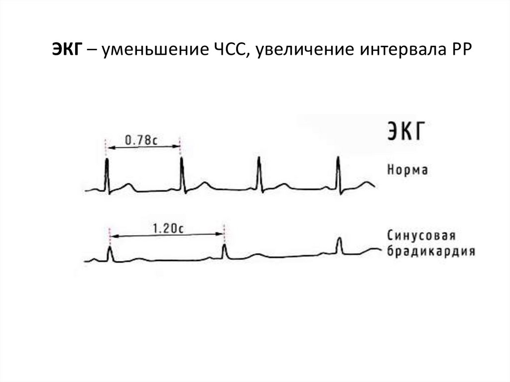 ЭКГ – уменьшение ЧСС, увеличение интервала РР