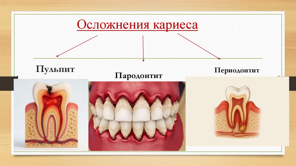 Осложнения кариеса