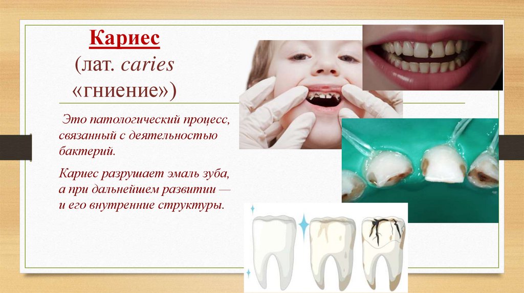 Кариес  (лат. caries  «гниение»)