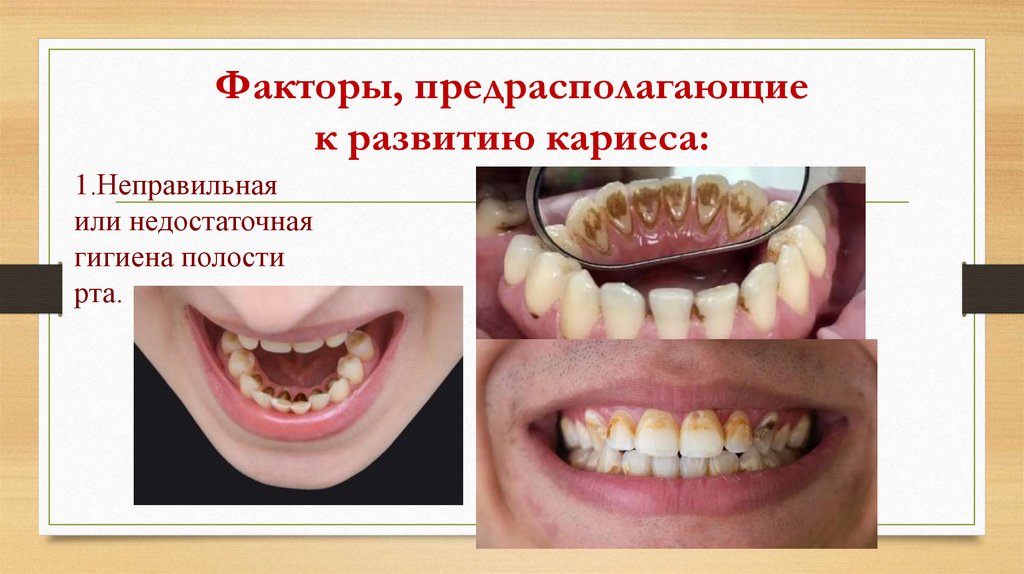 Факторы, предрасполагающие к развитию кариеса: