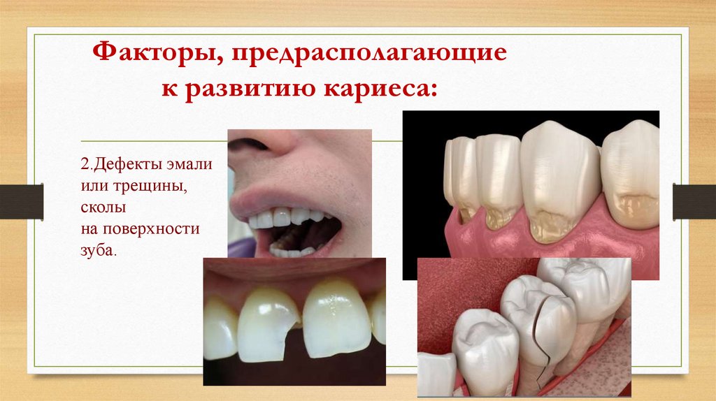 Факторы, предрасполагающие к развитию кариеса: